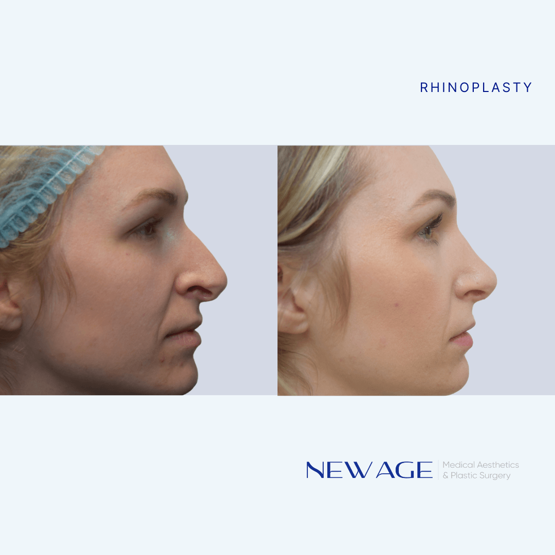 Top Rated Rhinoplasty Ottawa