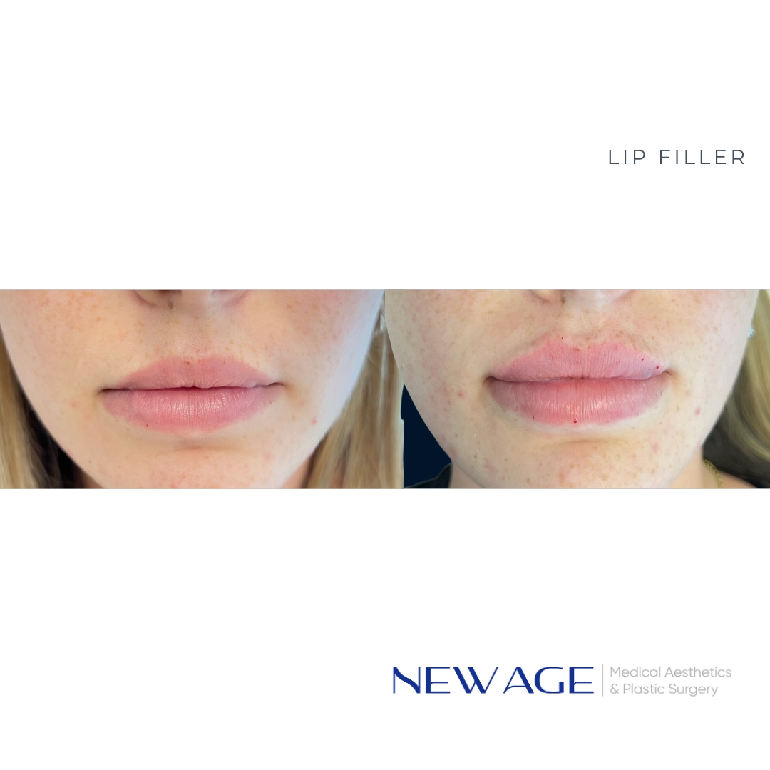 Lip Filler | New Age Aesthetics