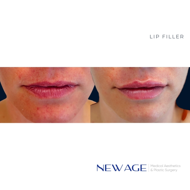 Lip Filler | New Age Aesthetics