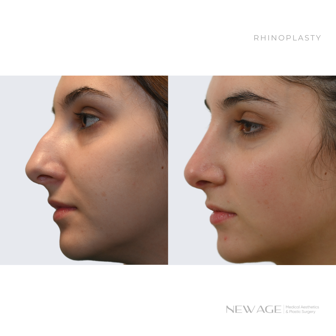 Before & After Rhinoplasty Ottawa