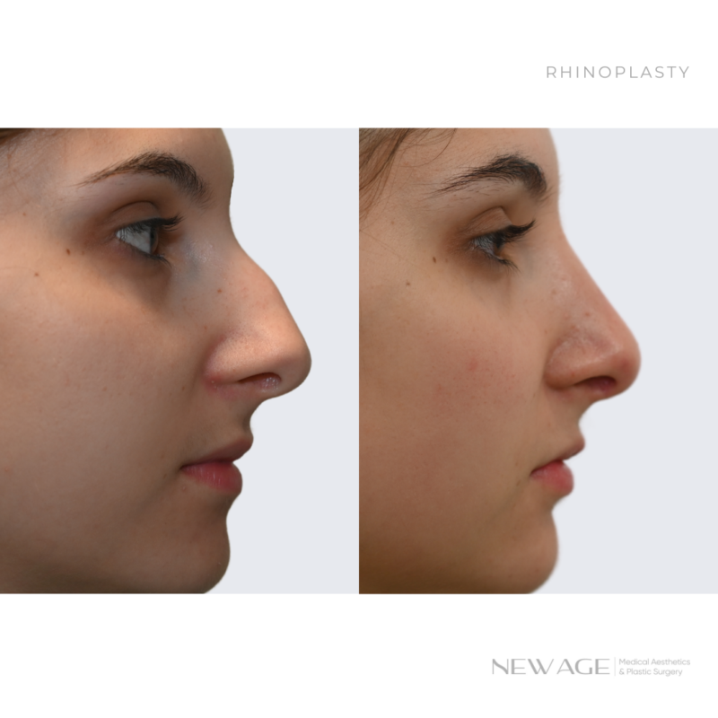 Before & After Rhinoplasty Ottawa