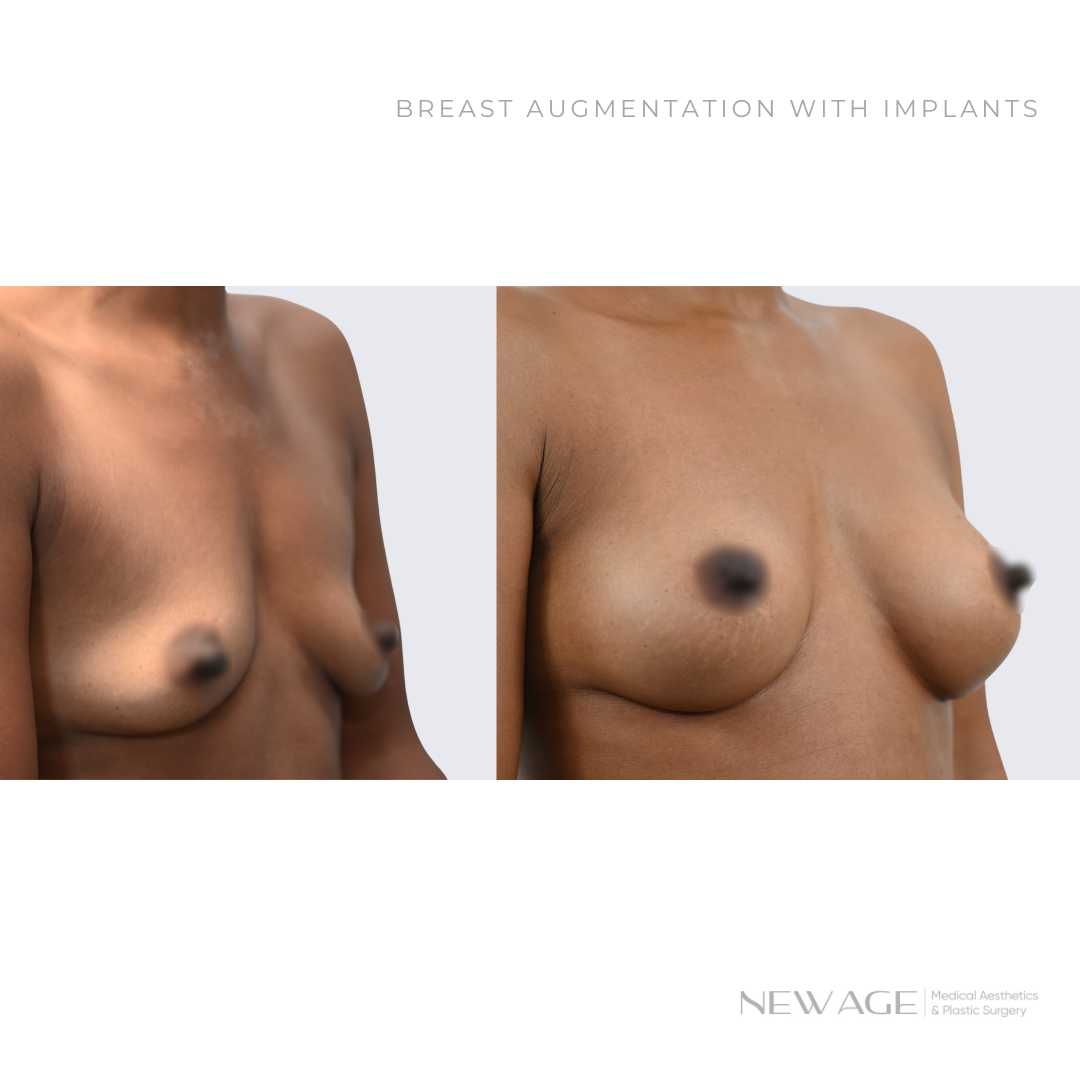 Breast Augmentation Before & After Ottawa Near Me New Age Plastic Surgery