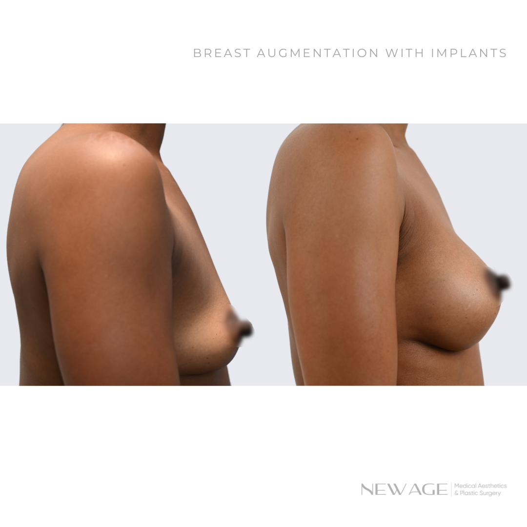 Breast Augmentation Before & After Ottawa Ontario New Age Plastic Surgery