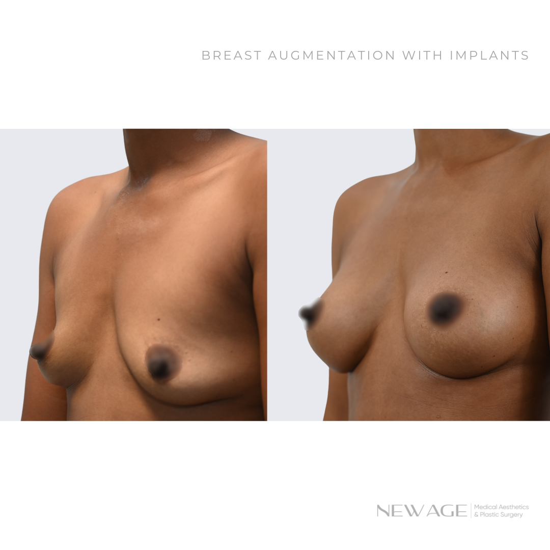 Breast Implants Before & After Ottawa New Age Plastic Surgery