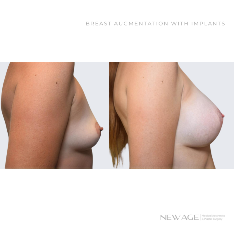 Before & After Photos of Breast Augmentation in Ottawa