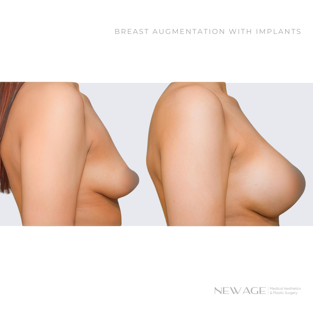 Before & After Photos of Breast Implants in Ottawa