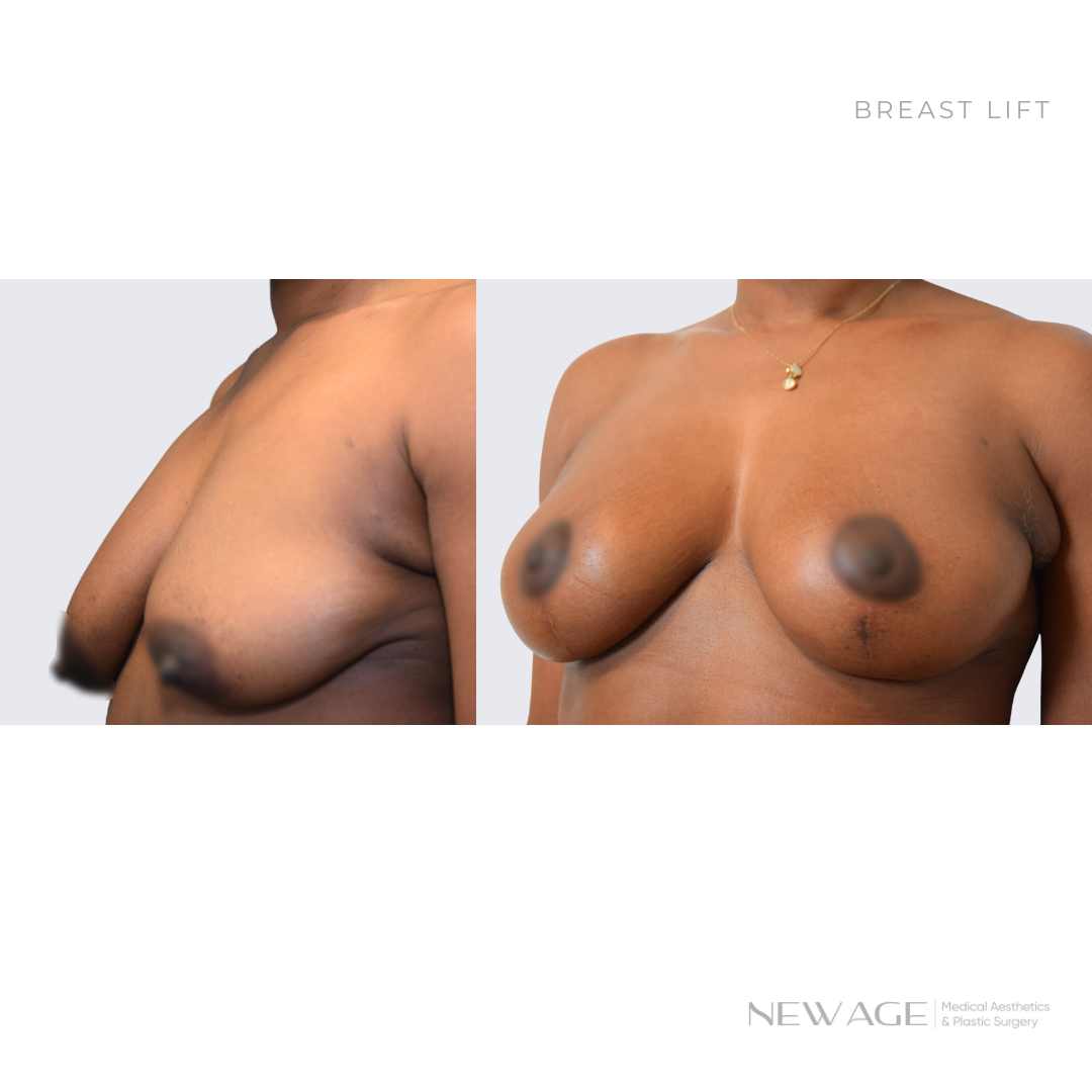 Breast Lift Surgery Before & After Photos Ottawa, Ontario