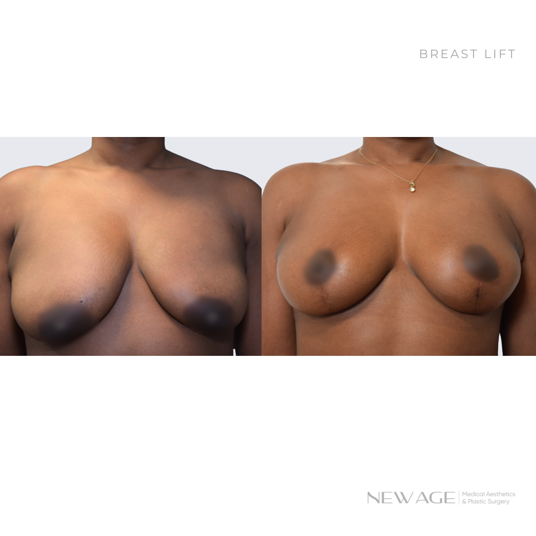 Breast Lift Surgery Before & After Photos Ottawa, Ontario