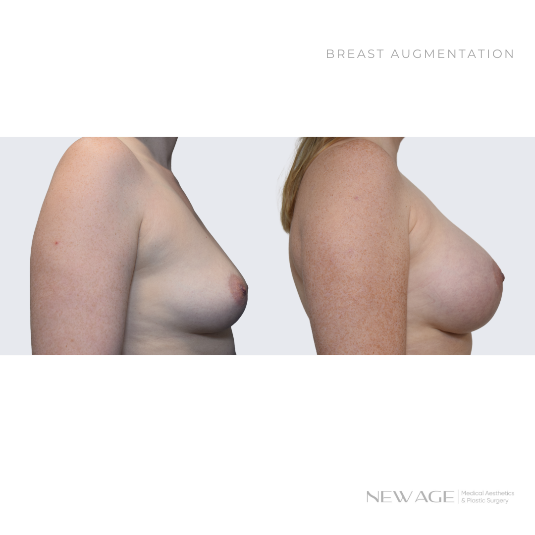 Before & After Breast Augmentation Photos Ottawa