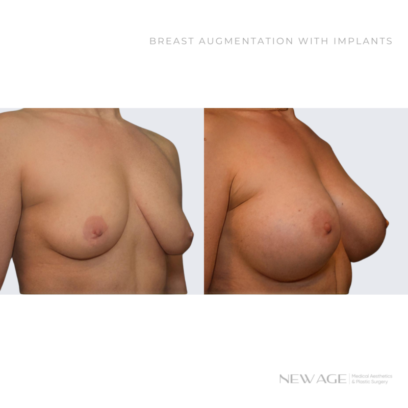 Breast Augmentation with Implants Ottawa, Ontario