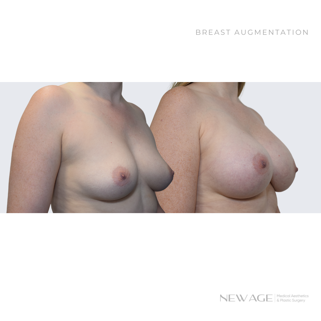 Breast Implants Before & After Photos Ottawa, Ontario Plastic Surgeon