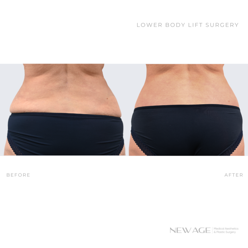 Lower Body Lift in Ottawa, Ontario