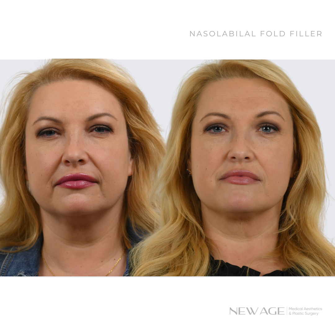 Nasolabial Fold Filler Ottawa, Ontario