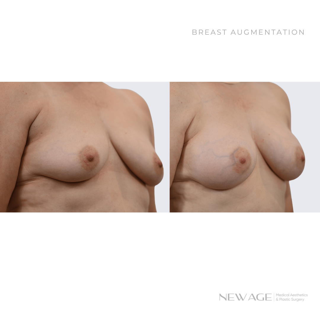 Before & After Photos of Breast Augmentation Ottawa, ON