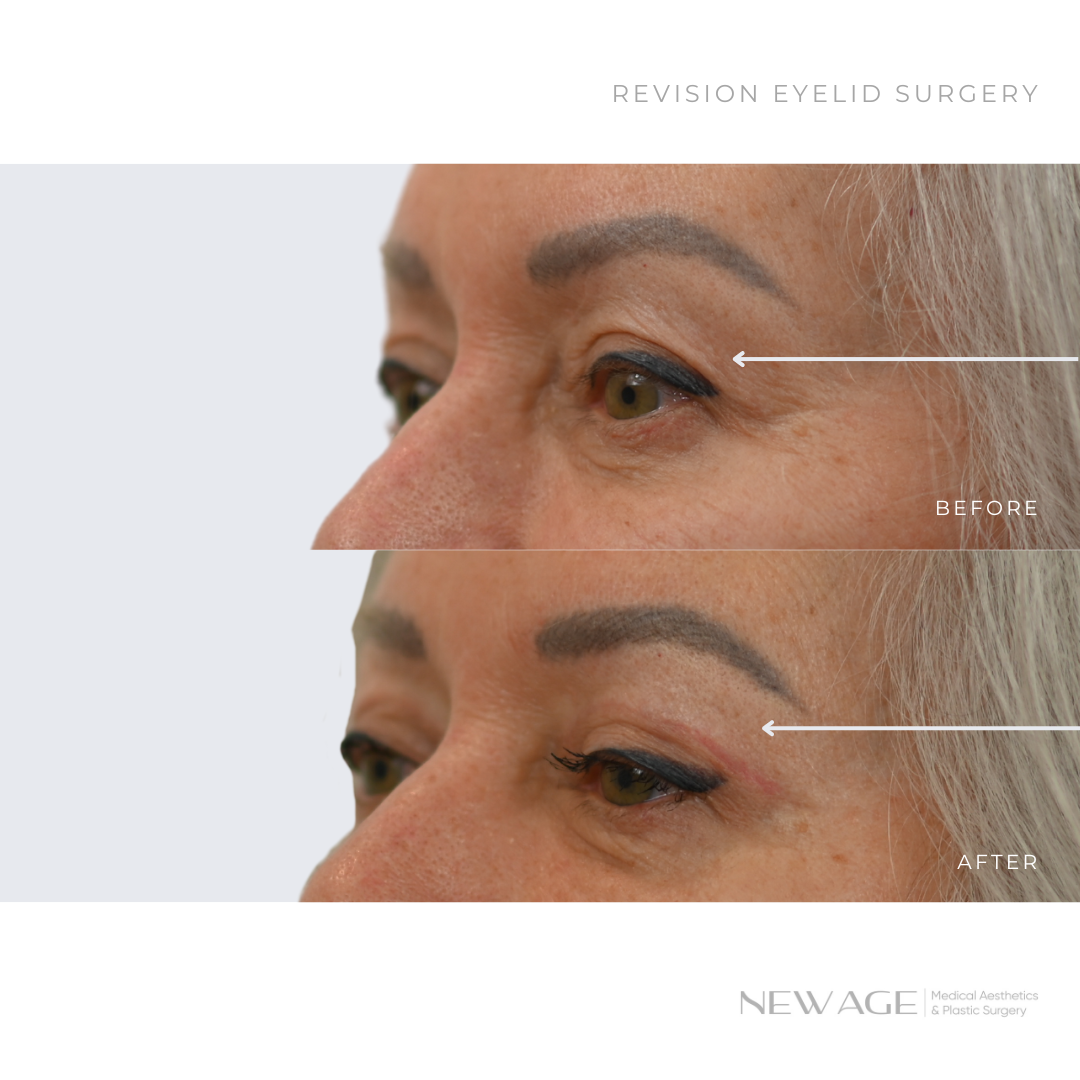 Before & After Eyelid Surgery Ottawa, Ontario