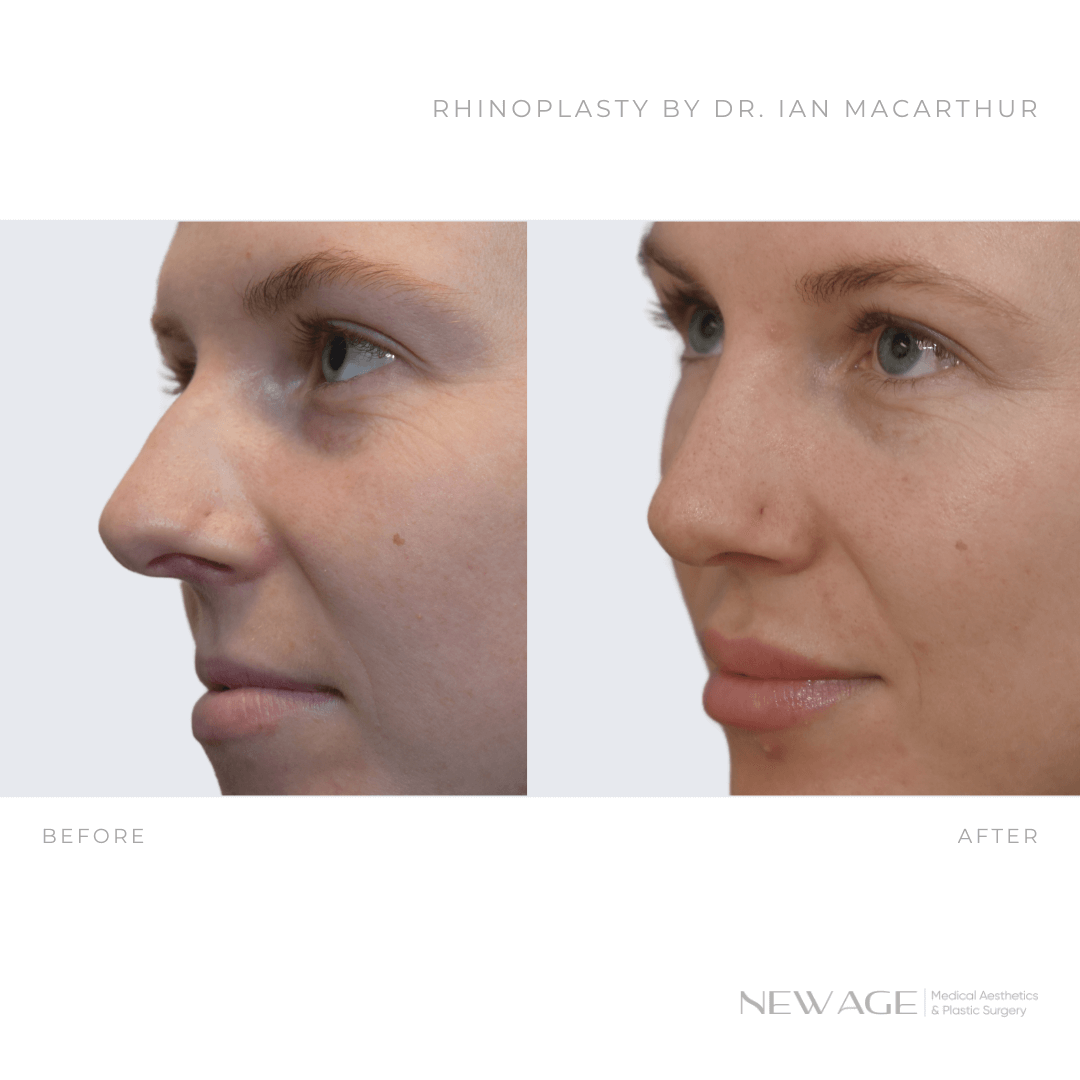 Rhinoplasty Before & After Photos Ottawa, Ontario New Age