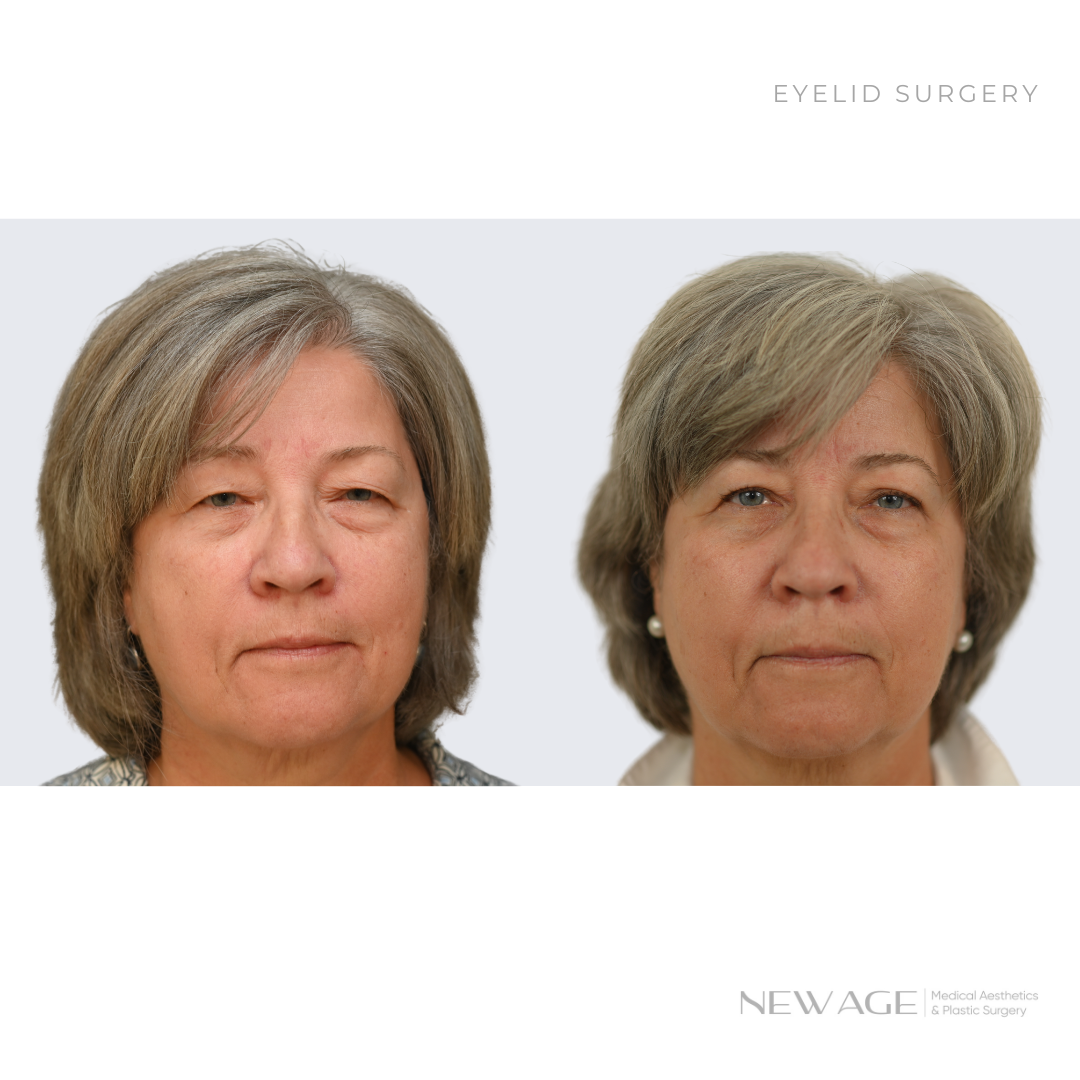 Before & After Eyelid Surgery Photos, Ottawa, Ontario, Plastic Surgeon