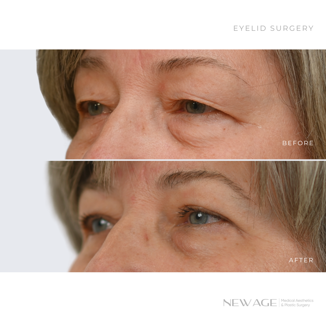 Eyelid Surgery Before & After Photos Ottawa, Ontario