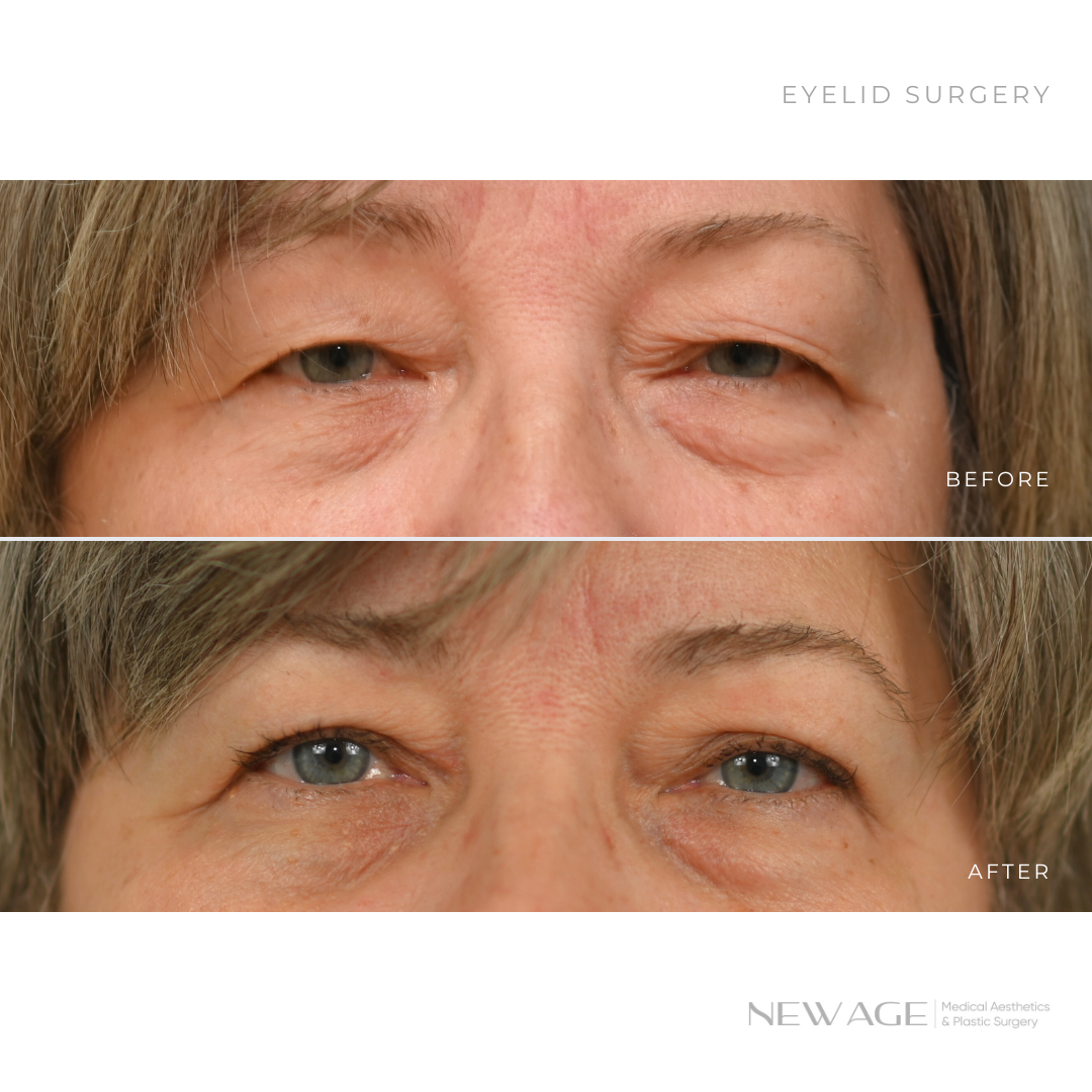 Eyelid Surgery in Ottawa, Ontario, Board Certified Plastic Surgeon