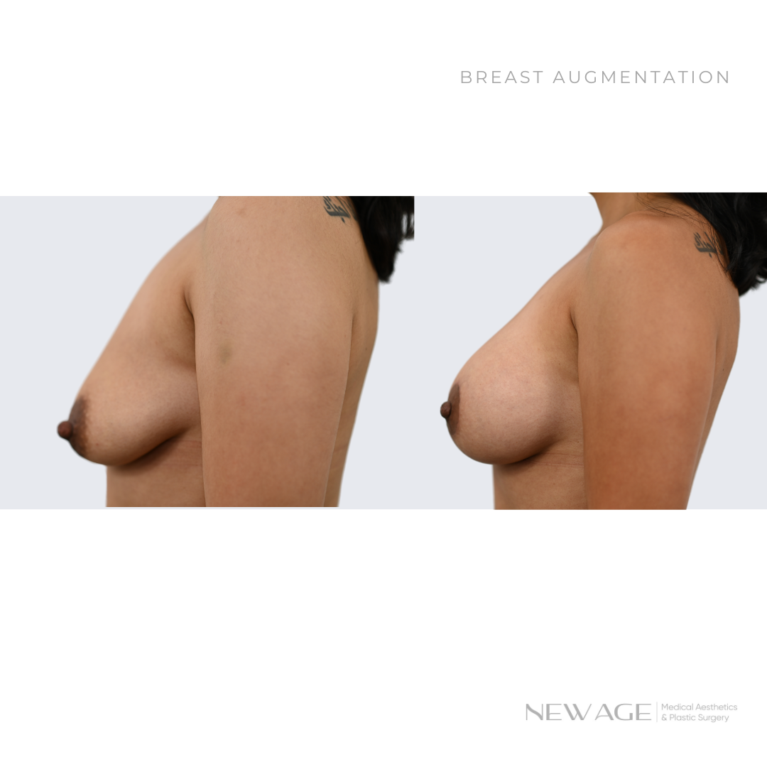 Before & After Breast Augmentation Ottawa, Ontario