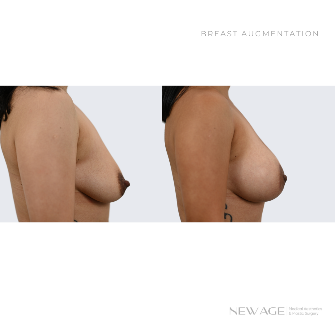 Before & After Photos Breast Augmentation Ottawa, Ontario Board Certified Plastic Surgeon