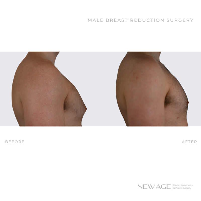 Male Breast Reduction Before & After Photos Gynecomastia in Ottawa, Ontario