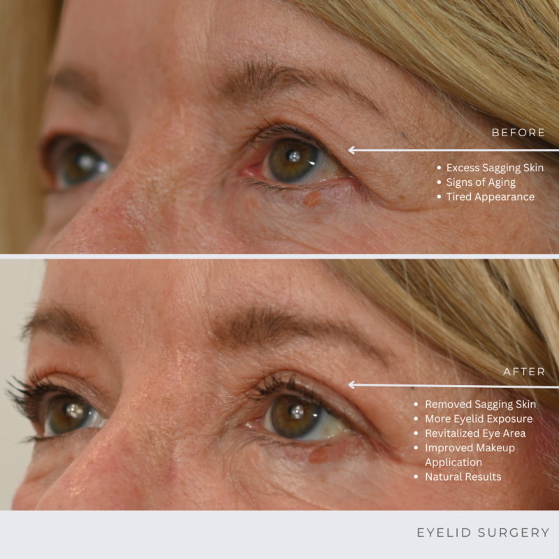 Before and After Eyelid Surgery Photos in Ottawa Plastic Surgery