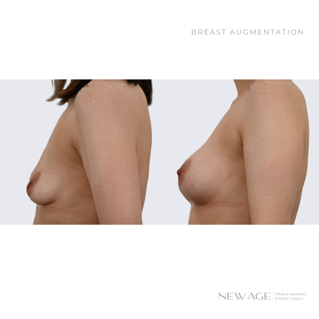 Breast Augmentation Before and After Ottawa