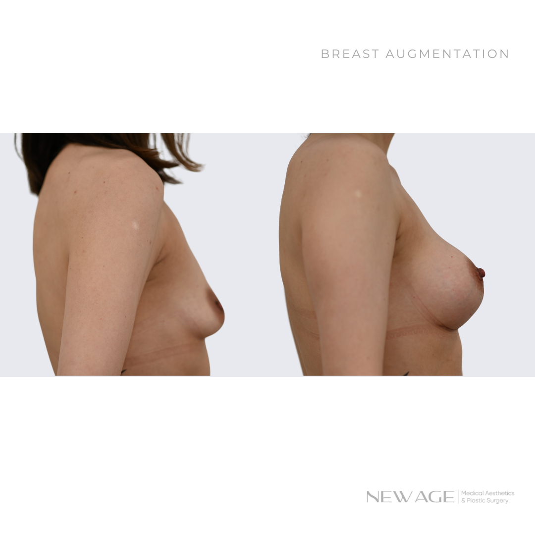 Breast Implants Before and After Ottawa, Ontario