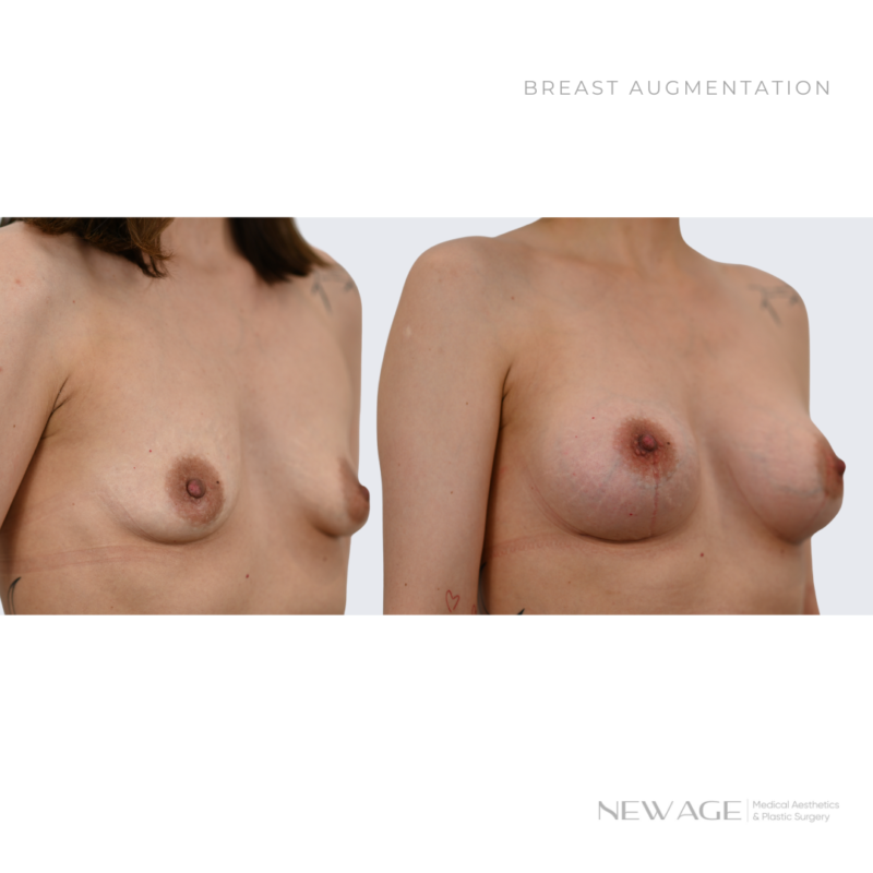 Breast Implants in Ottawa with Plastic Surgeon