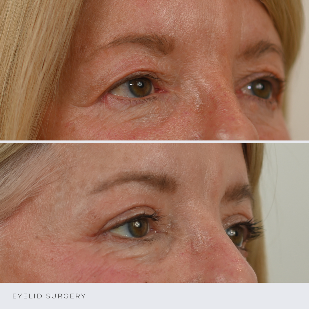 Eyelid Surgery Before and After Photos Ottawa, Ontario