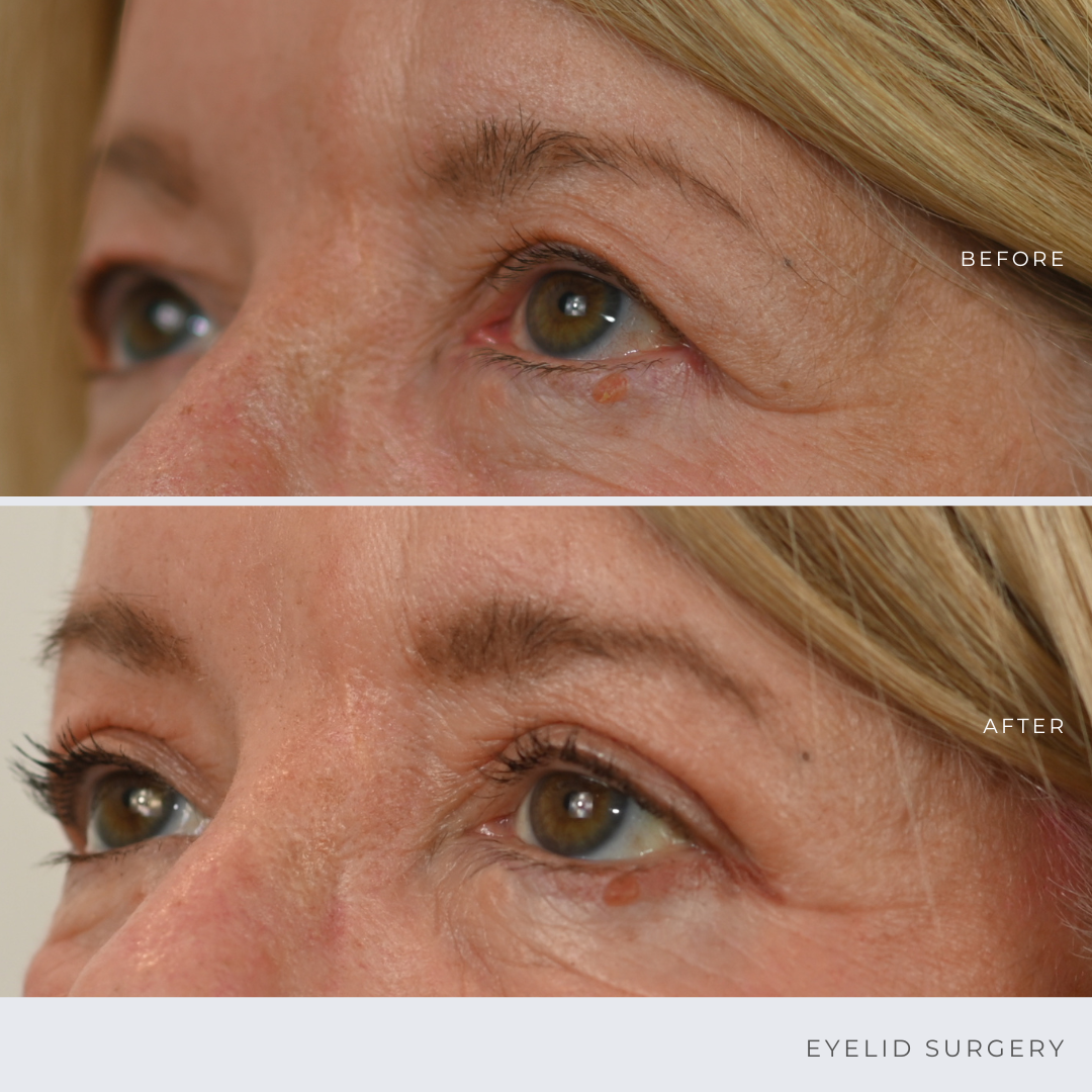 Eyelid Surgery in Ottawa Before & After Photos