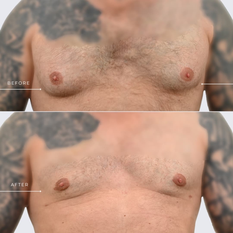 Male Breast Reduction Before & After Ottawa Plastic Surgeon