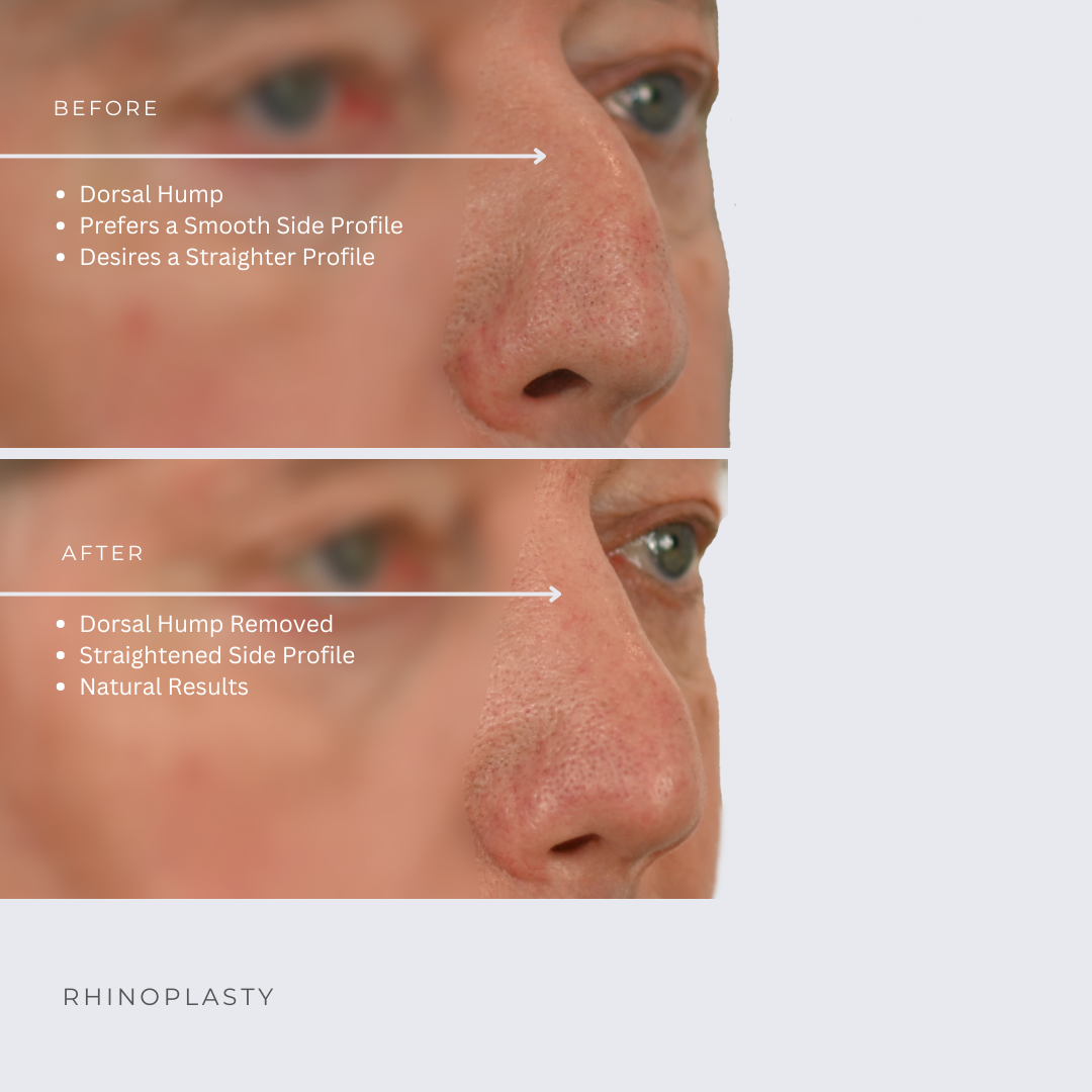Rhinoplasty Before & After Photos Ottawa