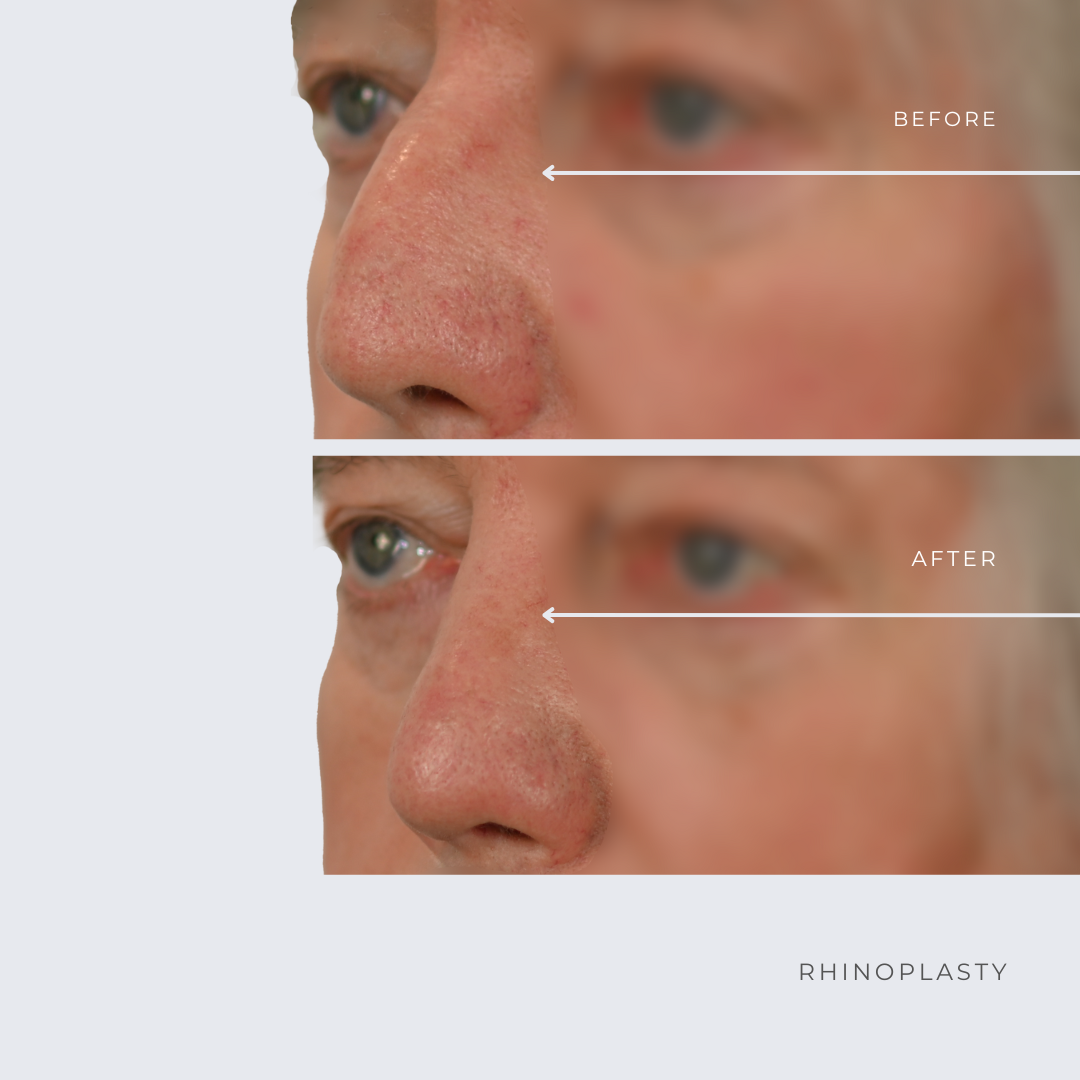 Rhinoplasty Before & Afters Ottawa