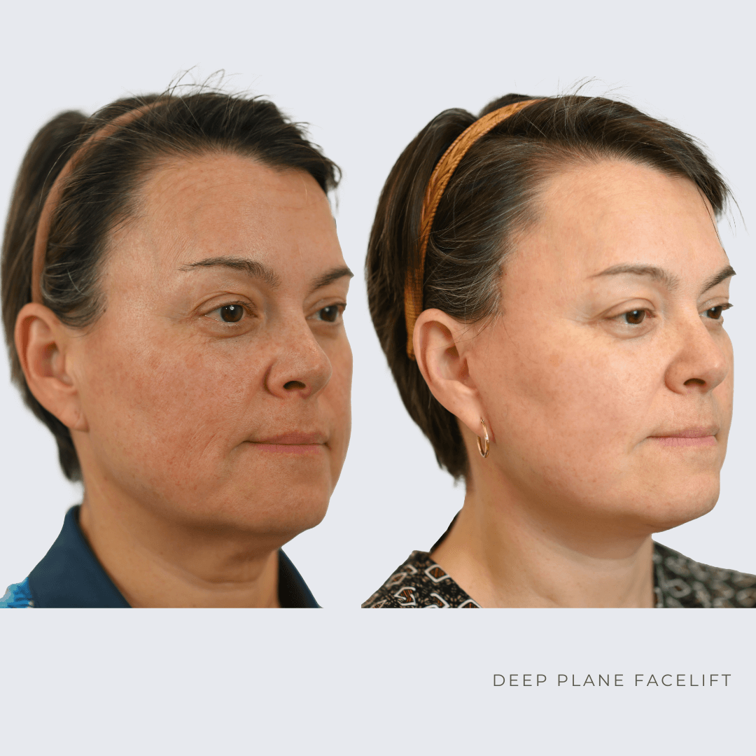 New Age Face lift Before and after Ottawa