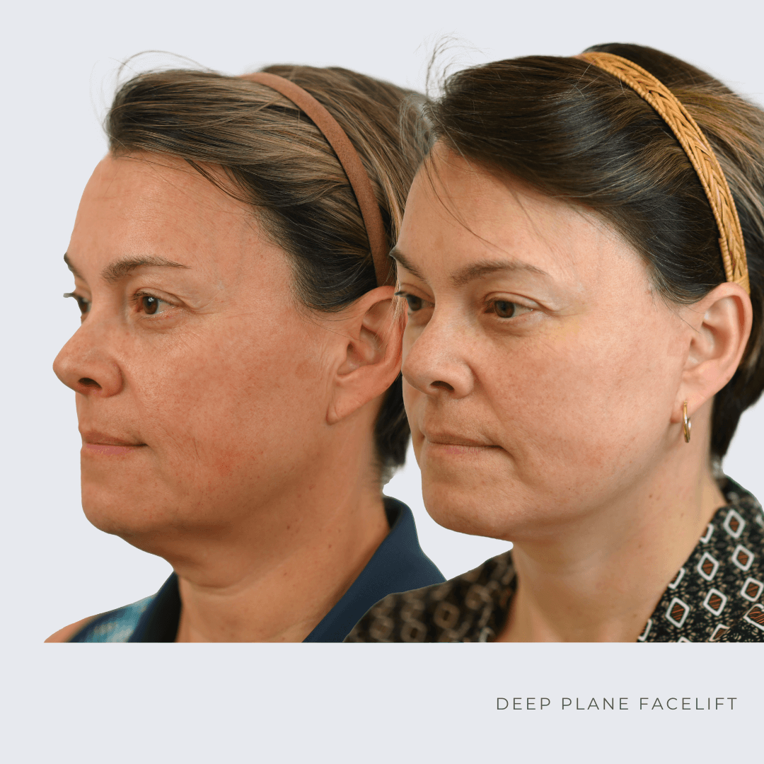 New Age Face lift Before and after Ottawa