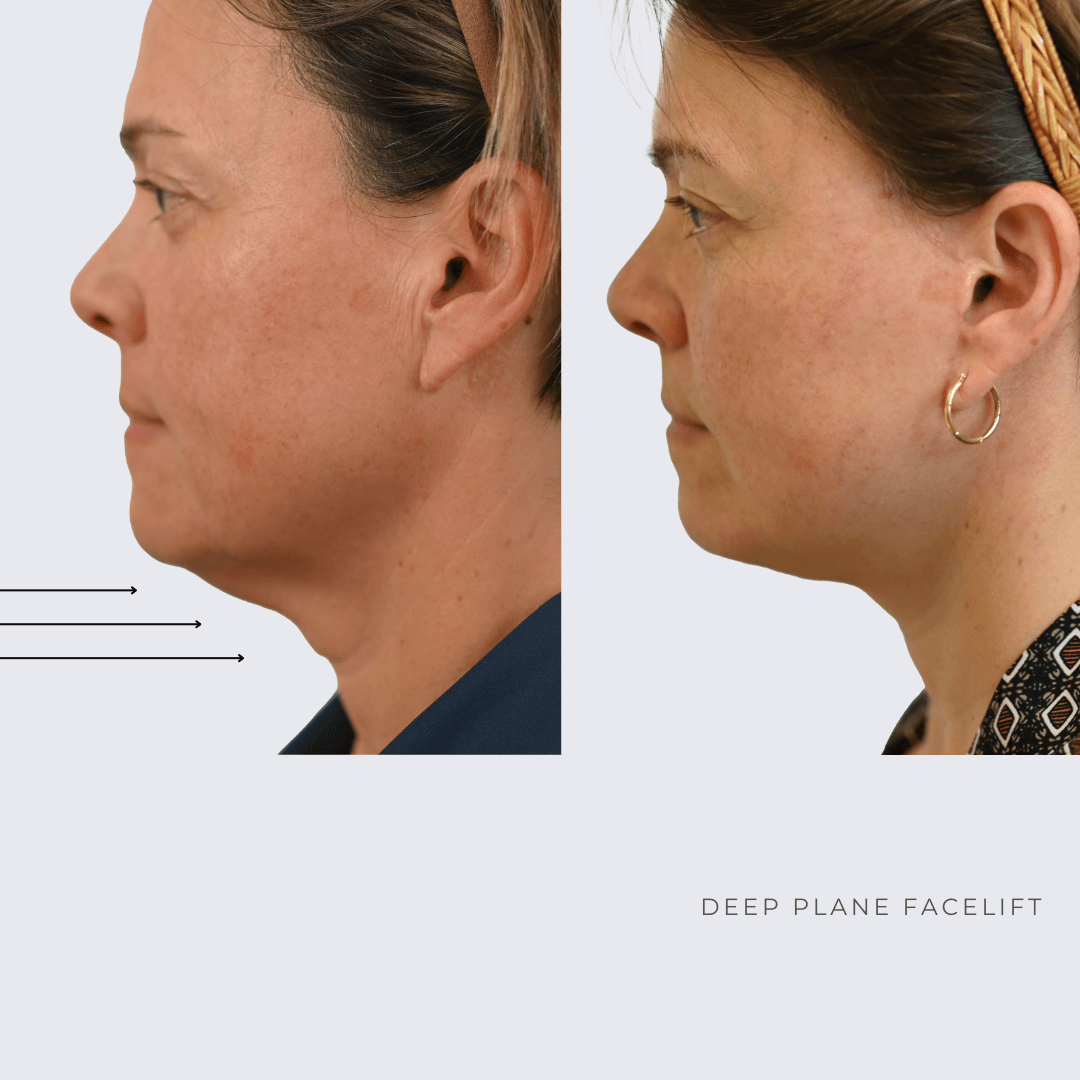 New Age Face lift Before and after Ottawa