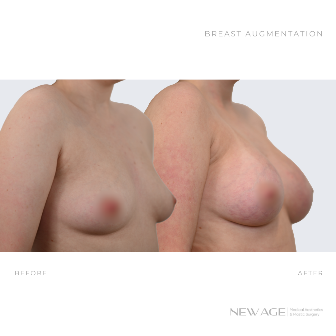 breast augmentation before after photos