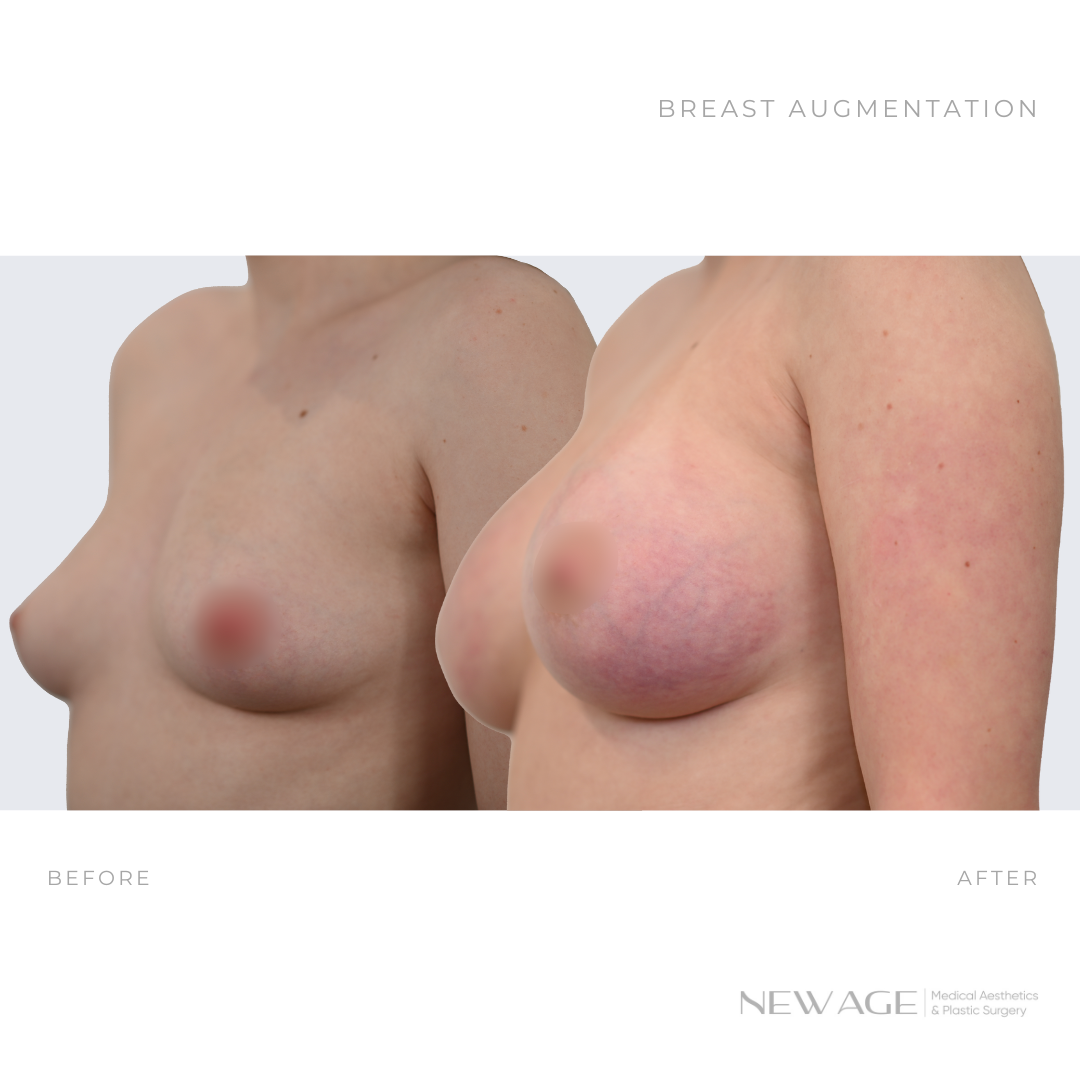 breast augmentation before after photos implant