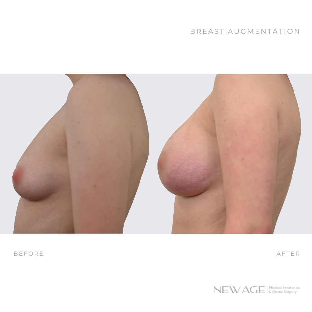 breast augmentation before after photos side