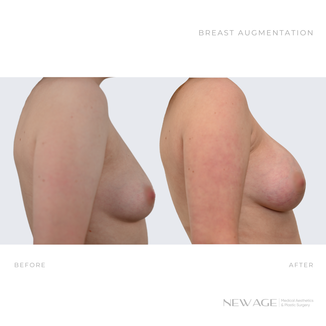 breast augmentation before after photos ottawa