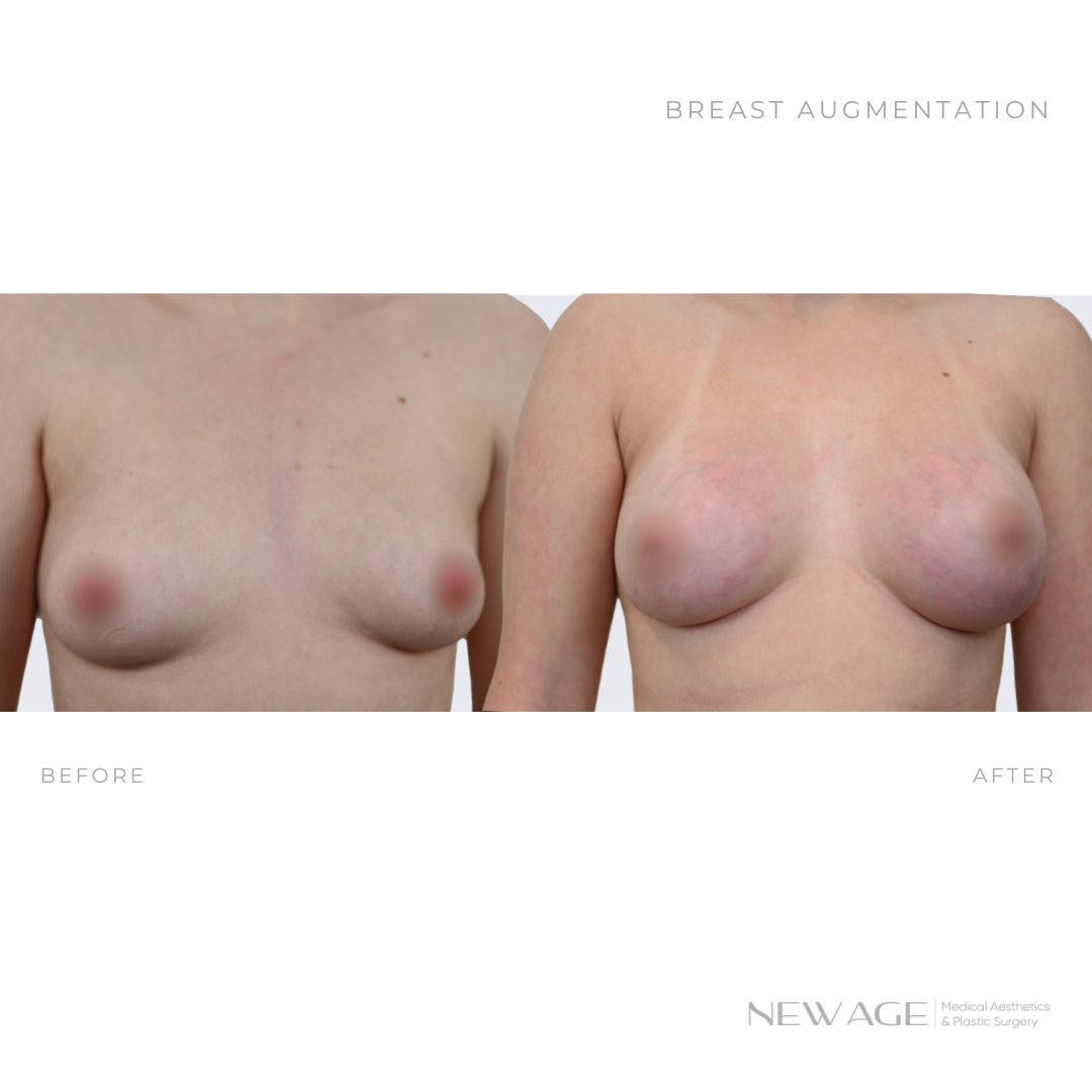 breast augmentation before after photos ottawa implants