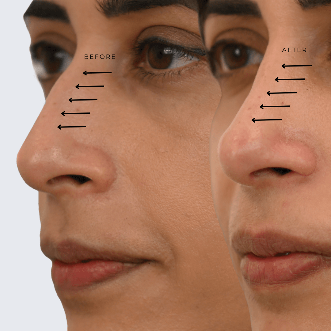Rhinoplasty Before and After Ottawa