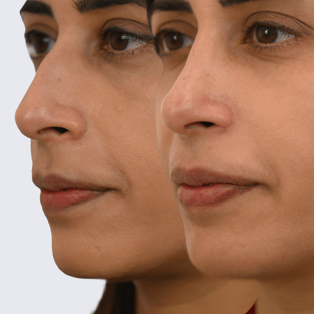 Rhinoplasty Before and After Ottawa
