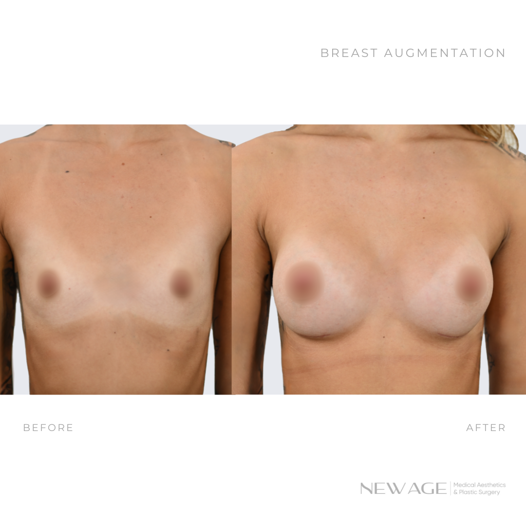 744723911-breast-augmetnation-before-after-photos-ottawa