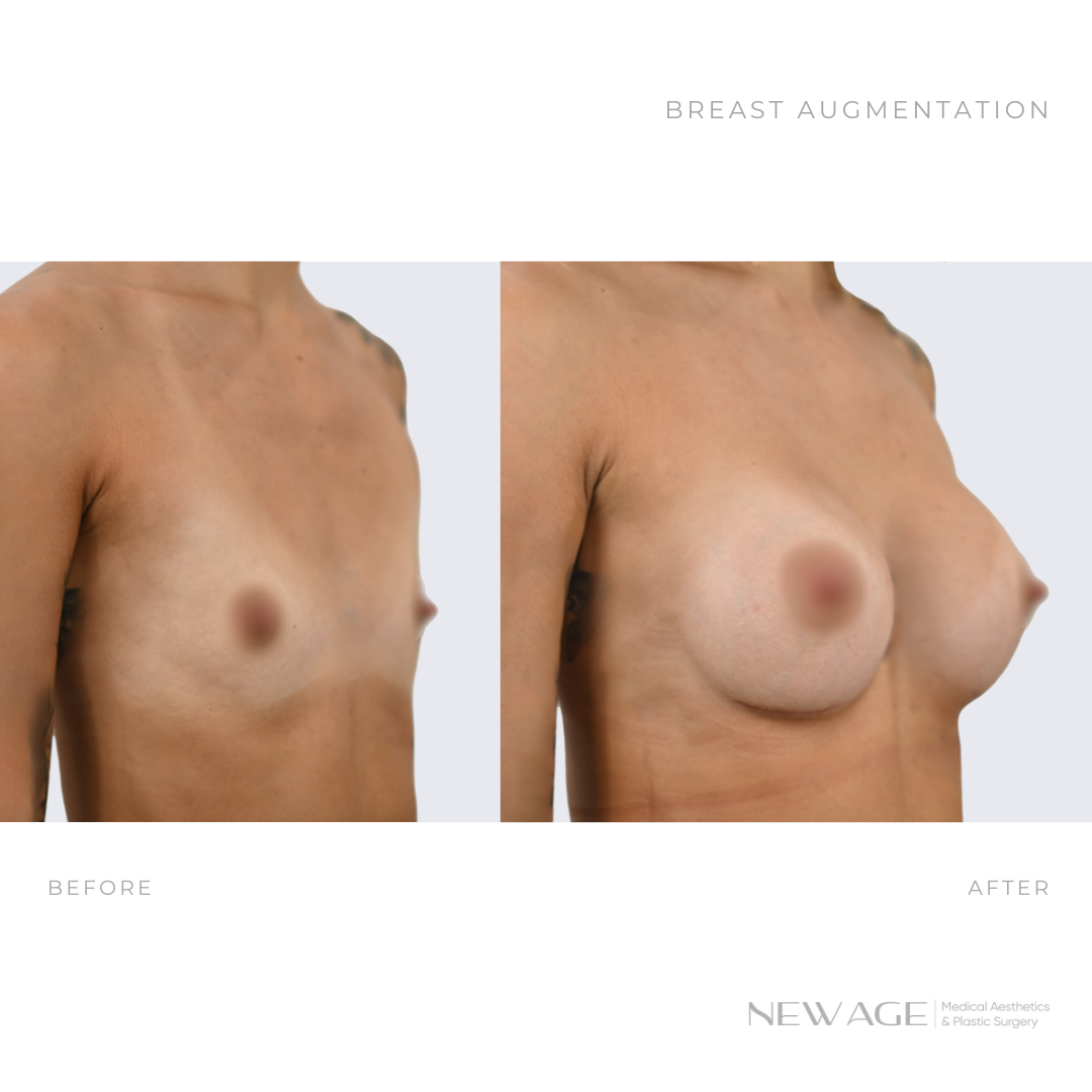 744723913-breast-implants-before-after-ottawa-plastic-surgeon