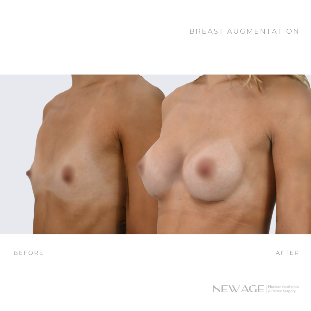 744723915-breast-implants-before-after-ottawa