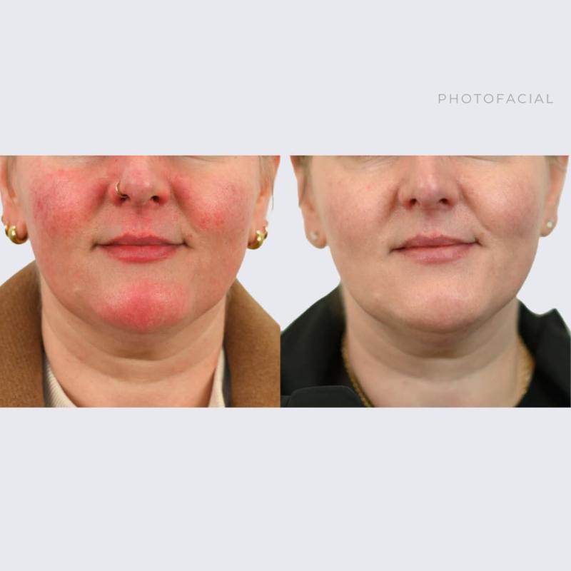 Before & After PhotoFacial Ottawa