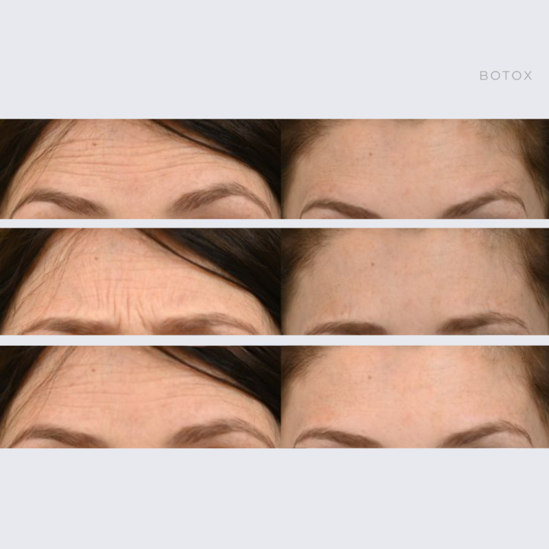 Botox Before & After in Ottawa, Ontario